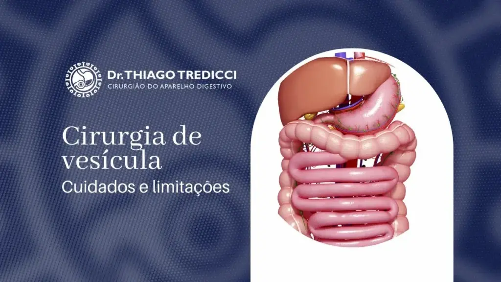 Quem fez cirurgia de vesícula pode se abaixar? Confira aqui! - Blog Dr ...